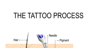 Laser Tattooentfernung – Bedeutung, Erklärung & Leserfragen