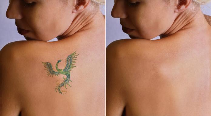 Tattooentfernung leicht erklärt Methoden, Kosten & Tipps vom Dermatologen Tattooentfernung leicht erklärt Methoden, Kosten & Tipps vom Dermatologen